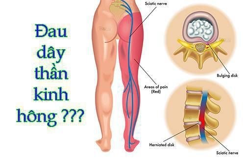 Đau dây thần kinh hông 