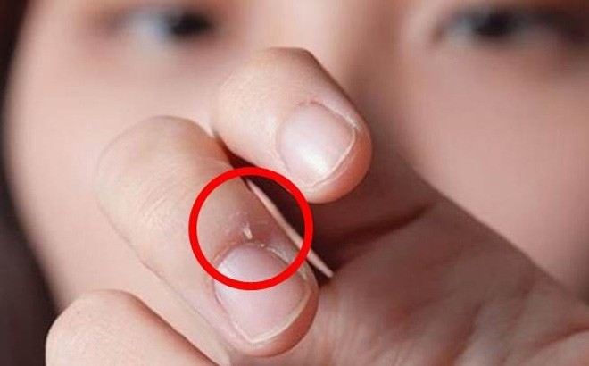 Những vết xước xung quanh móng