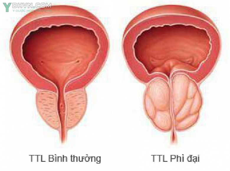 Dấu hiệu nhận biết phì đại tuyến tiền liệt