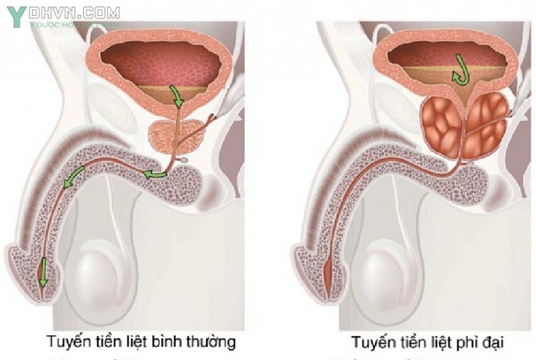 Triệu chứng của phì đại lành tính Tuyến tiền liệt: