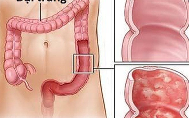 Bệnh viêm đại tràng 