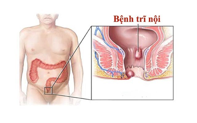 Trĩ nội