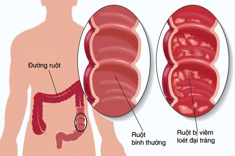 Phân loại và nguyên nhân gây bệnh viêm đại tràng mạn tính