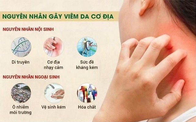 Triệu chứng bị viêm da cơ địa