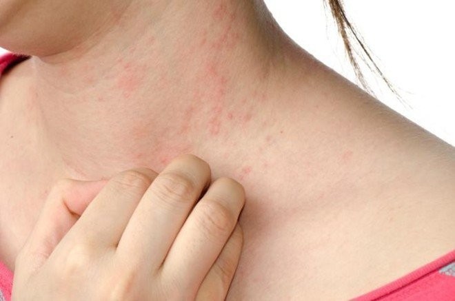 Vệ sinh da để hạn chế ngứa