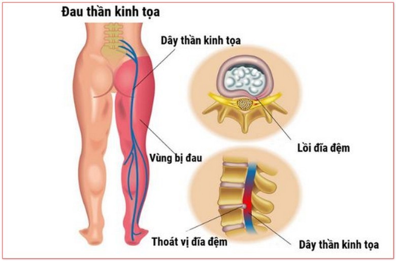 Bài thuốc trị đau thần kinh tọa do lạnh