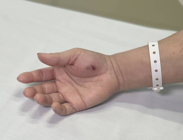 Nhiễm độc do bị con cu li cắn