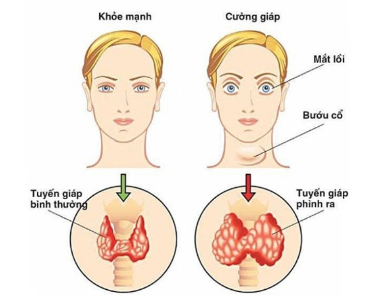 1. Triệu chứng của bệnh Basedow