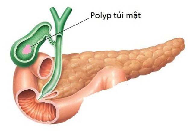 2. ‎‎‎Polyp túi mật khi nào có nguy cơ cao chuyển thành u ác tính?