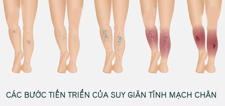 2. Nguyên nhân giãn tĩnh mạch chi hay gặp ở phụ nữ và các biến chứng của nó