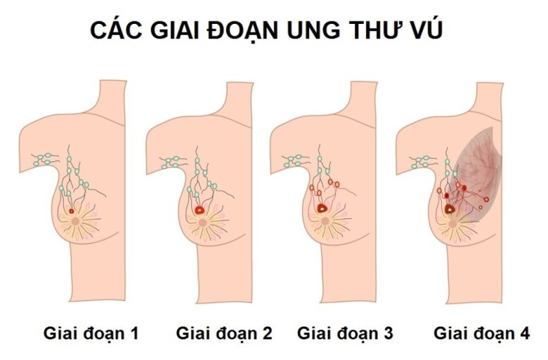 Về mặt bệnh lý ung thư vú có thể phân chia thành: