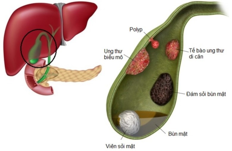 1.Nguyên nhân polyp túi mật