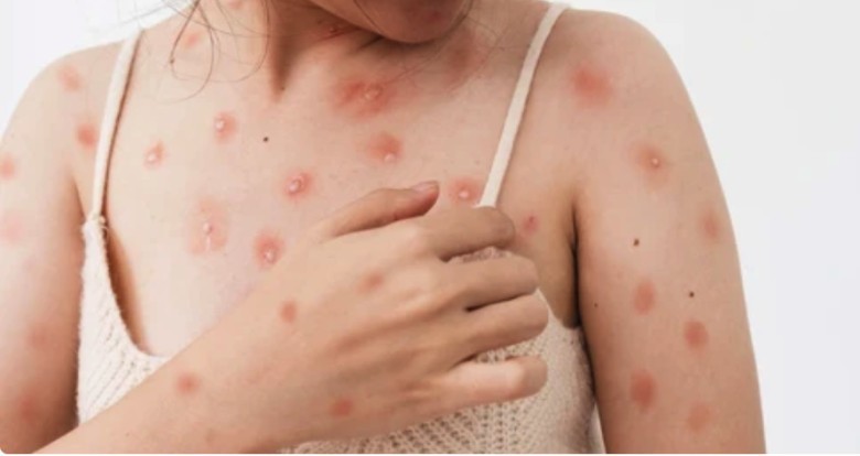 2. Cách bảo vệ bản thân khỏi lây nhiễm đậu mùa khỉ