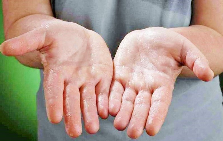 Có 3 thể bệnh: