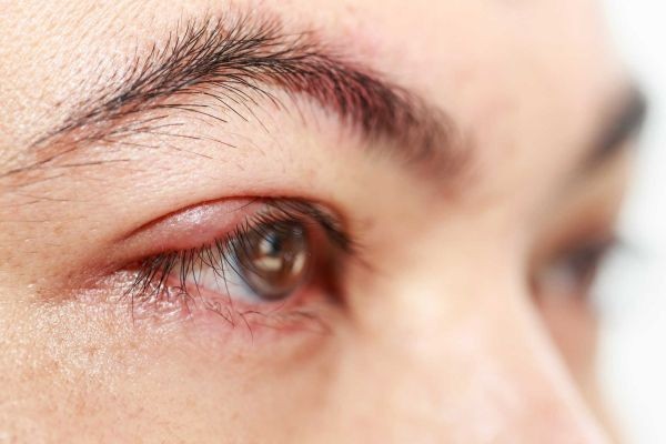 Dấu hiệu nhận biết khi bị dị ứng mắt