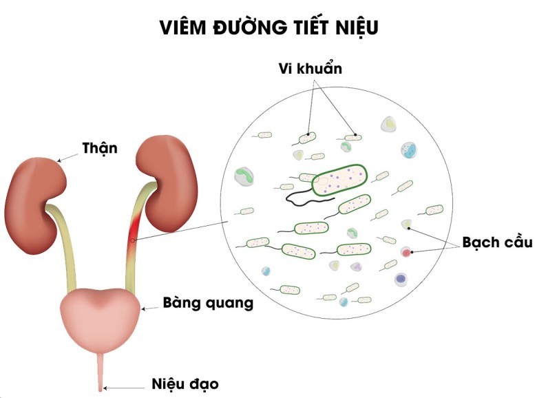 Xin giới thiệu một số loại trà dược chữa trị chứng bệnh này rất hiệu quả để bạn đọc tham khảo áp dụng.