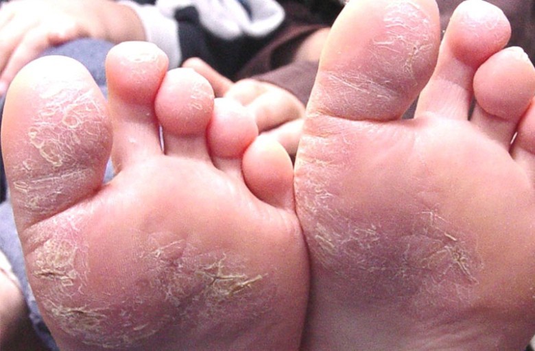 3. Triệu chứng của bệnh á sừng