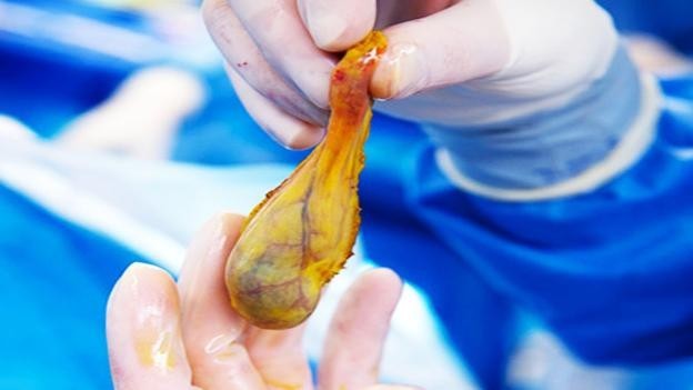 3. Khi nào cần cắt polyp túi mật?