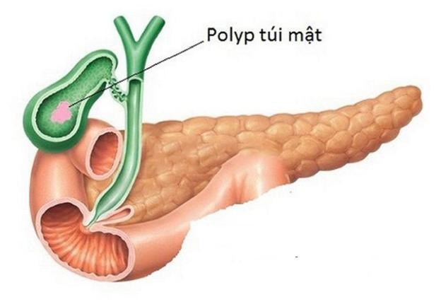 Chẩn đoán polyp túi mật