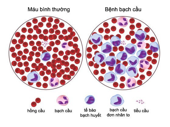 Các loại bệnh ung thư máu
