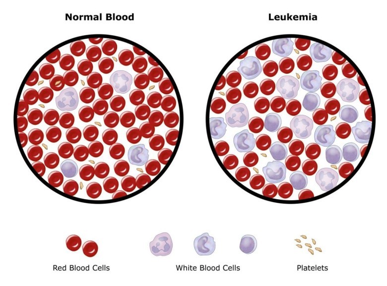 Dấu hiệu ung thư máu thể bệnh bạch cầu cấp (Leukemia)