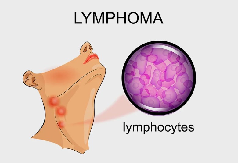 Dấu hiệu ung thư hạch Lymphoma