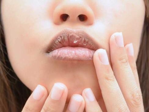 Phân biệt ung thư môi và viêm môi
