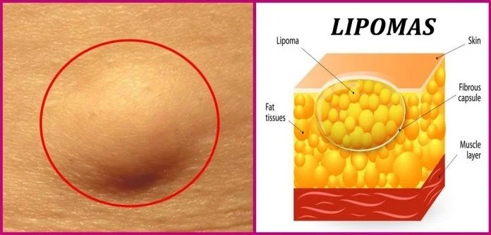 Các biến chứng bệnh u mỡ