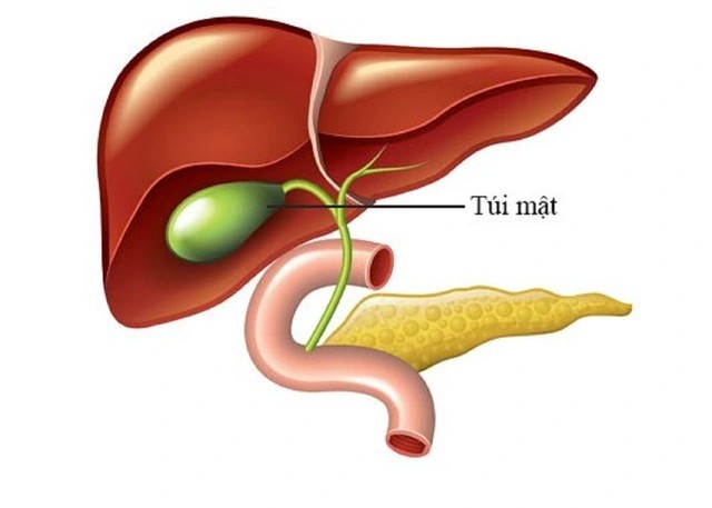 Polyp túi mật