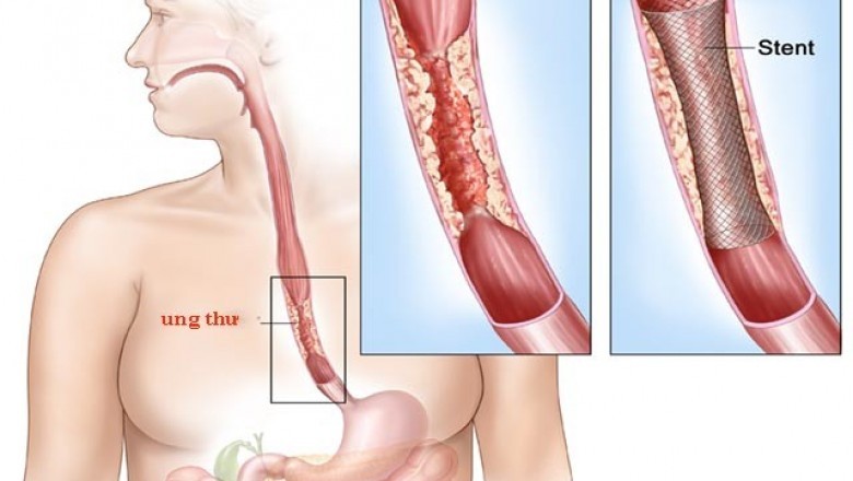 Những bài thuốc nam chữa ung thư thực quản