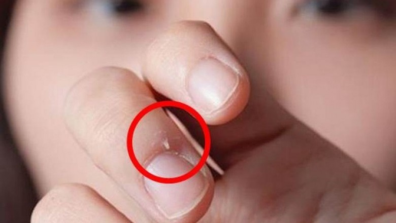 Những bệnh nguy hiểm biểu hiện trên móng, ngón tay thường gặp nhất