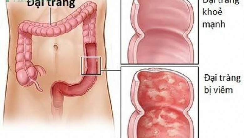 Những thực phẩm tốt và không tốt cho người bị bệnh viêm đại tràng mãn tính