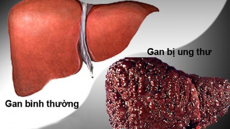 Phát hiện protein mới chống ung thư gan