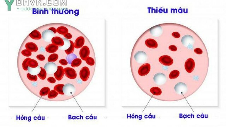 Món ăn bài thuốc từ thảo dược Việt Nam tốt cho người bị thiếu máu