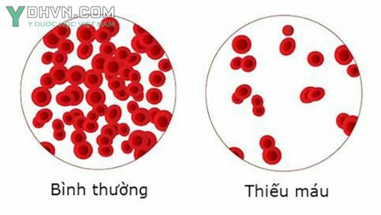 Bệnh thiếu máu: Nguyên nhân, Biểu hiện, Điều trị, Phòng ngừa như thế nào?