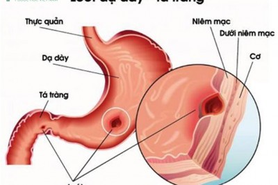 Chữa bệnh loét dạ dày,  tá tràng bằng những bài thuốc dân gian hiệu quả