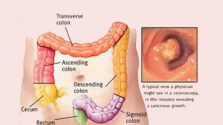 Vì sao nhiều người trong một nhà cùng bị ung thư đại trực tràng: theo Tiến sĩ Phạm Văn Bình