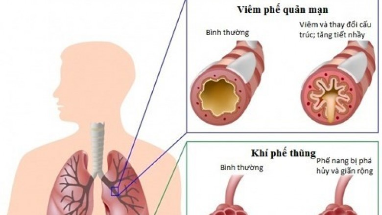 Hỗ trợ trị hen phế quản, hen suyễn, COPD theo đông y gia truyền 500 năm