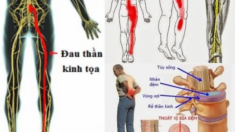 Hỗ trợ trị đau thần kinh tọa, đau dây thần kinh liên sườn theo đông y gia truyền 500 năm