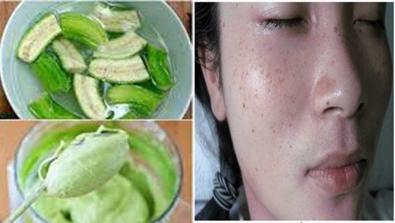 Hướng dẫn Trị Nám da, trị mụn trứng cá, giảm cân bằng quả chuối xanh cực tốt