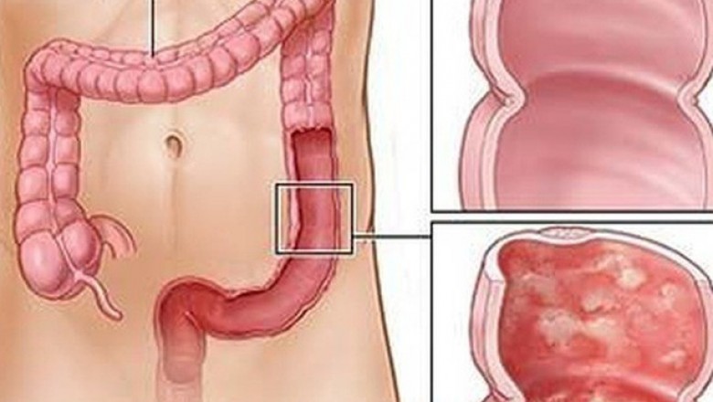 Bài thuốc đông y hay chữa bệnh Viêm đại tràng: theo Lương y Đình Thuấn 