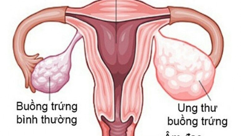 Bệnh Ung thư buồng trứng, căn bệnh nguy hiểm với chị em phụ nữ