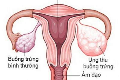 Bệnh Ung thư buồng trứng, căn bệnh nguy hiểm với chị em phụ nữ