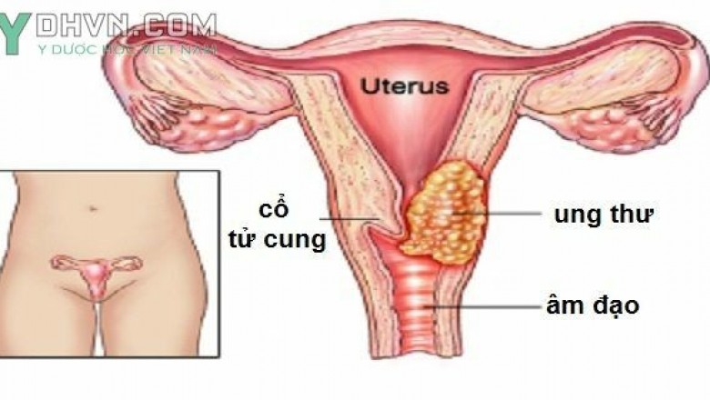Bệnh Ung thư cổ tử cung là gì?