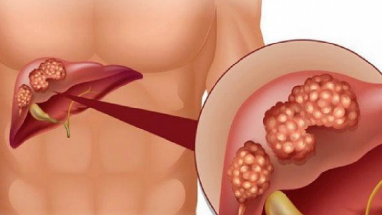 Dấu hiệu ung thư gan và các giai đoạn nhất định bạn phải biết
