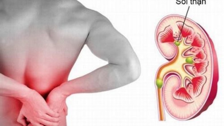 Bệnh sỏi thận, triệu chứng , nguyên nhân và cách chữa trị