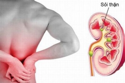 Bệnh sỏi thận, triệu chứng , nguyên nhân và cách chữa trị