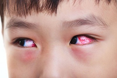 Bệnh đau mắt đỏ: Dấu hiệu và cách chữa hiệu quả nhất