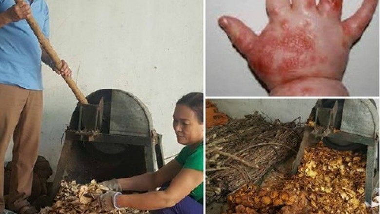 Lá tắm hỗ trợ chữa tay chân miệng chỉ 3 ngày là khỏi của y sĩ Nguyễn Văn Chắt ở Lạng Sơn