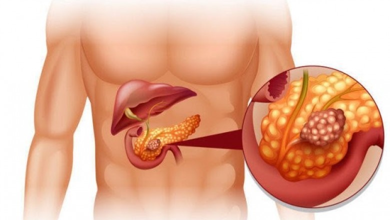 Phát hiện hợp chất ở loài cây nhiệt đới chữa khỏi ung thư tuyến tụy